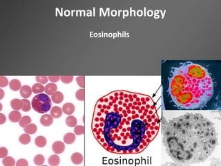 Normal Morphology
Eosinophils
 
