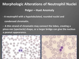 Morphologic Alterations of Neutrophil Nuclei
Pelger – Huet Anomaly
- A neutrophil with a hypolobulated, rounded nuclei and
condensed chromatin.
- A thin strand of chromatin may connect the lobes, creating a
pince-nez (spectacle) shape, or a larger bridge can give the nucleus
a peanut appearance.
 