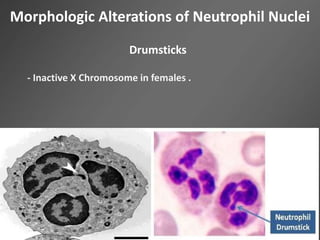 Morphologic Alterations of Neutrophil Nuclei
Drumsticks
- Inactive X Chromosome in females .
 