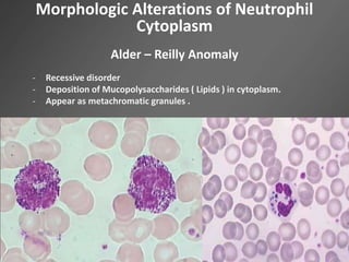Morphologic Alterations of Neutrophil
Cytoplasm
Alder – Reilly Anomaly
- Recessive disorder
- Deposition of Mucopolysaccharides ( Lipids ) in cytoplasm.
- Appear as metachromatic granules .
 