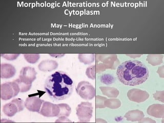 Morphologic Alterations of Neutrophil
Cytoplasm
May – Hegglin Anomaly
- Rare Autosomal Dominant condition .
- Presence of Large Dohle Body-Like formation ( combination of
rods and granules that are ribosomal in origin )
 