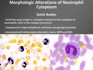 Morphologic Alterations of Neutrophil
Cytoplasm
Dohle Bodies
- Small blue-gray (single or multiple) inclusions in the cytoplasm of
neutrophils, often at the margins (eccentric).
- Composed of rough endoplasmic reticulum and glycogen granules.
- Associated with inflammatory disorders, burns, MPD and MDS
 