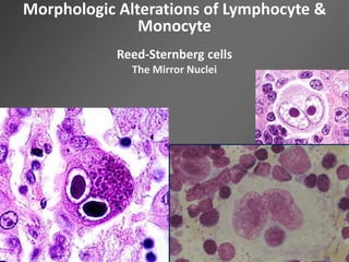 Morphologic Alterations of Lymphocyte &
Monocyte
Reed-Sternberg cells
The Mirror Nuclei
 