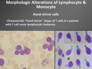 Morphologic Alterations of Lymphocyte &
Monocyte
Hand-mirror cells
- Characteristic “hand mirror” shape of T cells in a patient
with T-cell acute lymphocytic leukemia.
 