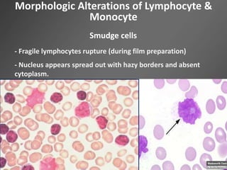 Morphologic Alterations of Lymphocyte &
Monocyte
Smudge cells
- Fragile lymphocytes rupture (during film preparation)
- Nucleus appears spread out with hazy borders and absent
cytoplasm.
 