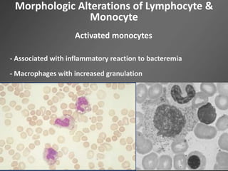 Morphologic Alterations of Lymphocyte &
Monocyte
Activated monocytes
- Associated with inflammatory reaction to bacteremia
- Macrophages with increased granulation
 