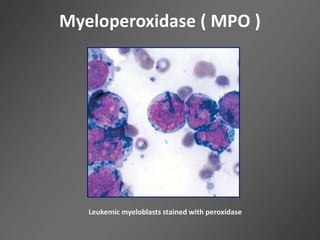 Myeloperoxidase ( MPO )
Leukemic myeloblasts stained with peroxidase
 