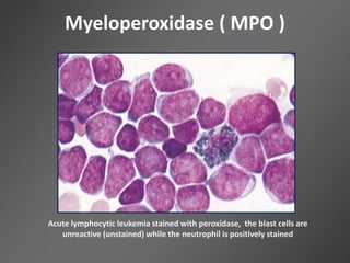 Myeloperoxidase ( MPO )
Acute lymphocytic leukemia stained with peroxidase, the blast cells are
unreactive (unstained) while the neutrophil is positively stained
 