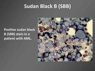 Sudan Black B (SBB)
Positive sudan black
B (SBB) stain in a
patient with AML.
 