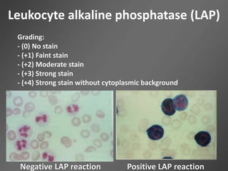 Leukocyte alkaline phosphatase (LAP)
Grading:
- (0) No stain
- (+1) Faint stain
- (+2) Moderate stain
- (+3) Strong stain
- (+4) Strong stain without cytoplasmic background
Positive LAP reactionNegative LAP reaction
 
