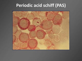 Periodic acid schiff (PAS)
 