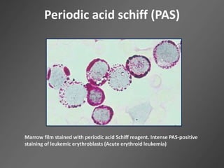 Periodic acid schiff (PAS)
Marrow film stained with periodic acid Schiff reagent. Intense PAS-positive
staining of leukemic erythroblasts (Acute erythroid leukemia)
 