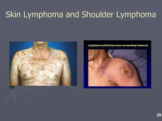 Skin Lymphoma and Shoulder Lymphoma
29
 