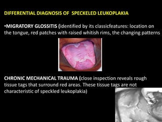 DIFFERENTIAL DIAGNOSIS OF SPECKELED LEUKOPLAKIA
•MIGRATORY GLOSSITIS (identified by its classicfeatures: location on
the tongue, red patches with raised whitish rims, the changing patterns
CHRONIC MECHANICAL TRAUMA (close inspection reveals rough
tissue tags that surround red areas. These tissue tags are not
characteristic of speckled leukoplakia)
 