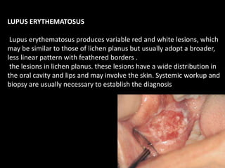 LUPUS ERYTHEMATOSUS
Lupus erythematosus produces variable red and white lesions, which
may be similar to those of lichen planus but usually adopt a broader,
less linear pattern with feathered borders .
the lesions in lichen planus. these lesions have a wide distribution in
the oral cavity and lips and may involve the skin. Systemic workup and
biopsy are usually necessary to establish the diagnosis
 