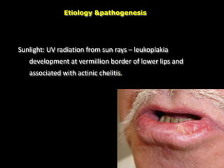 Sunlight: UV radiation from sun rays – leukoplakia
development at vermillion border of lower lips and
associated with actinic chelitis.
Etiology &pathogenesis
 