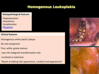 Homogenous Leukoplakia
Clinical features
Homogenous white patch/ plaque
No red component
Fine, white, grainy texture.
Low risk malignant transformation rate
Localized or extensive
“Beach at ebbing tide appearance, cracked mud appearance”
Histopathological features
•Hyperkeratosis
•Acanthosis
•Lymphocytes
•Dysplasia
 