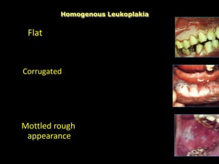 Mottled rough
appearance
Homogenous Leukoplakia
Flat
Corrugated
 