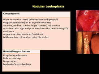 Nodular Leukoplakia
Clinical features
White lesion with raised, pebbly surface with polypoid
outgrowths (nodules) on an erythematous base
Very fine, pin head sized or larger, rounded, red or white
Associated with high malignant transformation rate showing ED/
carcinoma.
Appearance often similar to Candidiasis
Mild complaints of localized pain/ discomfort
Histopathological features
Irregular hyperkeratosis
Bulbous rete pegs
Lymphocytes
Moderate/Severe dysplasia
 