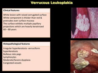 Verrucous Leukoplakia
Clinical features
White lesion with raised corrugated surface
White component is thicker than red &
protrudes over surface mucosa
The surface exhibits multiple papillary
projections which are heavily keratinized
60 – 80 years
Histopathological features
Irregular hyperkeratosis- verruciform
hyperkeratosis
Bulbous rete pegs
Lymphocytes
Moderate/Severe dysplasia
Congested vessels
 