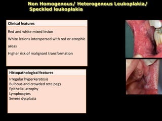 Non Homogenous/ Heterogenous Leukoplakia/
Speckled leukoplakia
Clinical features
Red and white mixed lesion
White lesions interspersed with red or atrophic
areas
Higher risk of malignant transformation
Histopathological features
Irregular hyperkeratosis
Bulbous and crowded rete pegs
Epithelial atrophy
Lymphocytes
Severe dysplasia
 