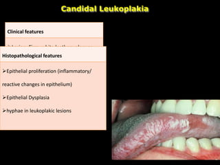 Candidal Leukoplakia
Clinical features
Lesion: Firm, white leathery plaques
Site: Cheeks, lips, palate, tongue
Diagnosis: PAS (Periodic Acid Schiff) +.
Histopathological features
Epithelial proliferation (inflammatory/
reactive changes in epithelium)
Epithelial Dysplasia
hyphae in leukoplakic lesions
 