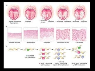 49
Investigations
Loss of Heterozygosity (LOH)
Loss of genomic material in 1 pair of chromosomes is = loss of
heterozygosity (LOH)
LOH at chromosomal regions containing tumor suppressor
genes might be related to the process of malignant
development
LOH, particularly at chromosome arms 3 & 9, has been
associated with a possibility of malignant development of
premalignant lesions
Microsatellite analysis, RFLP
 