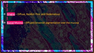  Gingiva – Diffuse, Reddish Pink and Oedematous
 Buccal Mucosa – Diffused brownish pigmentation over the mucosa
 