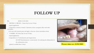 FOLLOW UP
RX, DATE-13/03/2021
• RETINO-A CREAM – 2 times/day for next 10 days
(topical application)
Composition: tretinoin (vitamin A derivative) shows synergistic effect with other
antioxidant .
(to be mix with turmeric paste and apply to that area- better antioxidant action)
• CANDID – B-2 times/day for next 10 days
(topical application)
Composition: (1) 1%clotrimazole (anti fungal action)
(2) 0.025%beclometasone ( corticosteroid –for reducing the inflammation in
the erythematous area).
(patient is recalled after 10 days) Picture taken on -13/03/2021
 