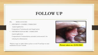 FOLLOW UP
RX, DATE-23/03/2021
• OINTMENT –CANDID- 2 TIMES/DAY
(topical application)
Composition:1%clotrimazole (anti fungal action)
• OINTMENT KENACORT- 2 TIMES/DAY
(topical application)
Composition:0.1%triamcinalone acetonide (corticosteroid –for
reducing the inflammation)
*Patient is kept on online follow up due to covid 19 and kept on same
medication for next 3 month. Picture taken on- 23/03/2021
 