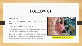 FOLLOW UP
DATE-02/07/2021
PATIENT VISITED TO DEPARTMENT FOR THE
FOLLOW UP
EXAMINATION OF THE LESION-
The central erythema of the lesion is markedly reduced
to half and its nodular presentation is lost.
Patient is advised for surgical excision of the remaining
lesion and for that he is referred to the department of
oral and maxillofacial surgery for further treatment. Picture taken on -02/07/2017
 