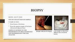 BIOPSY
DATE -02/07/2021
SITE OF COLLECTION OF SAMPLE-
2 sample are taken:
 From Centre of the lesion
 From the superior margin of the lesion
with normal adjacent tissue
SAMPLE IS SENDED TO THE
DEPARTMENT OF ORAL PATHOLOGY
AND MICROBIOLOGY FOR THE
ANALYSIS.
(Sample collection for biopsy) ( two sample ae taken from
different sites around the
lesion)
 