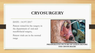 CRYOSURGERY
DATE : 14/07/2017
Patient visited for the surgery in
the department of oral and
maxillofacial surgery,
Patient vitals are in the normal
range
PREOPERATIVE PICTURE OF LESION BEFORE
THE CRYOSURGERY
 