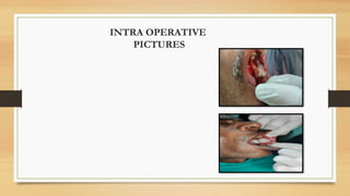 INTRA OPERATIVE
PICTURES
 