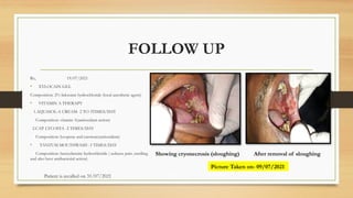 FOLLOW UP
Rx, 19/07/2021
• XYLOCAIN GEL
Composition: 2% lidocaine hydrochloride (local anesthetic agent)
• VITAMIN A THERAPY
1.AQUASOL-A CREAM- 2 TO 3TIMES/DAY
Composition: vitamin A(antioxidant action)
2.CAP. LYCOSTA -2 TIMES/DAY
Composition: lycopene and carotene(antioxidant)
• TANTUM MOUTHWASH -3 TIMES/DAY
Composition: benzydamine hydrochloride ( reduces pain ,swelling
and also have antibacterial action)
Patient is recalled on 31/07/2021
Showing cryonecrosis (sloughing) After removal of sloughing
Picture Taken on- 09/07/2021
 
