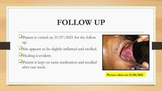 FOLLOW UP
Patient is visited on 31/07/2021 for the follow
up.
Site appears to be slightly inflamed and swelled.
Healing is evident.
Patient is kept on same medication and recalled
after one week.
Picture taken on-31/08/2021
 