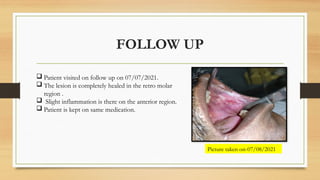FOLLOW UP
 Patient visited on follow up on 07/07/2021.
 The lesion is completely healed in the retro molar
region .
 Slight inflammation is there on the anterior region.
 Patient is kept on same medication.
Picture taken on-07/08/2021
 