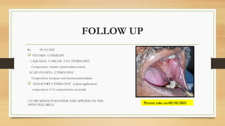 FOLLOW UP
Rx 09/10/2021
 VITAMIN A THERAPY
1.AQUASOL-A CREAM- 2 TO 3TIMES/DAY
Composition: vitamin A(antioxidant action)
2.CAP. LYCOSTA -2 TIMES/DAY
Composition: lycopene and carotene(antioxidant)
 KENACORT-2 TIMES/DAY (topical application)
composition: 0.1% triamcinolone acetonide
( TO BE MIXED TOGETHER AND APPLIED ON THE
AFFECTED AREA)
Picture take on-09/10/2021
 