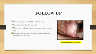 FOLLOW UP
 Patient visited on 23/10/2021 for follow up.
 Lesion appear to be almost healed.
 There is no swelling, erythema is evident on the target
site.
 Patient do not have any complain of pain or burning
sensation over that area.
Picture taken on-23/10/2021
 