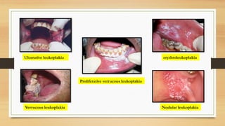 Ulcerative leukoplakia
Verrucous leukoplakia
Proliferative verrucous leukoplakia
erythroleukoplakia
Nodular leukoplakia
 