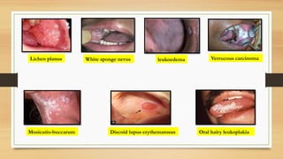 Lichen planus
Discoid lupus erythematosus
leukoedema Verrucous carcinoma
Mosicatio-buccarum
White sponge nevus
Oral hairy leukoplakia
 