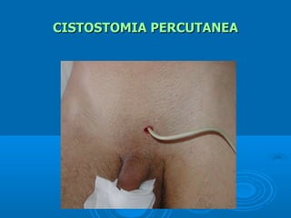 CISTOSTOMIA PERCUTANEA
 
