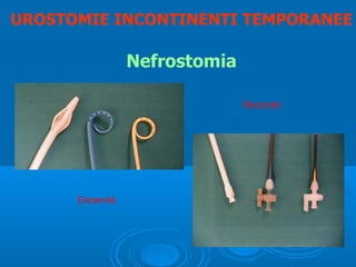 UROSTOMIE INCONTINENTI TEMPORANEE

                  Nefrostomia

                                Raccordo




      Estremità
 