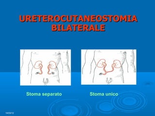 URETEROCUTANEOSTOMIA
                 BILATERALE




            Stoma separato   Stoma unico


14/03/12
 