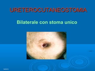 URETEROCUTANEOSTOMIA

            Bilaterale con stoma unico




14/03/12
 