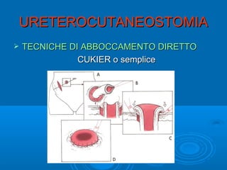 URETEROCUTANEOSTOMIA
   TECNICHE DI ABBOCCAMENTO DIRETTO
               CUKIER o semplice
 