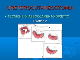 URETEROCUTANEOSTOMIA
   TECNICHE DI ABBOCCAMENTO DIRETTO
                  Straffon 2
 