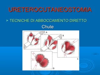 URETEROCUTANEOSTOMIA
   TECNICHE DI ABBOCCAMENTO DIRETTO
                 Chute
 