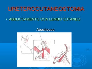 URETEROCUTANEOSTOMIA
   ABBOCCAMENTO CON LEMBO CUTANEO

               Abeshouse
 