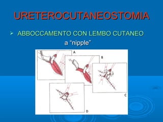 URETEROCUTANEOSTOMIA
   ABBOCCAMENTO CON LEMBO CUTANEO
               a “nipple”
 